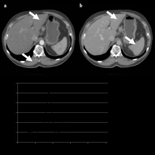 2.2 Multi-phase method for CT images Figure 2.11 Dual-phase liver examination: in arterial phase (a) the muscles, in portal-venous phase (b) the spleen has similar intensity as the liver (see arrows).