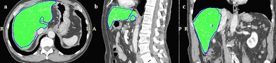 2.2 Multi-phase method for CT images over-segmentation can affect different parts of the liver.
