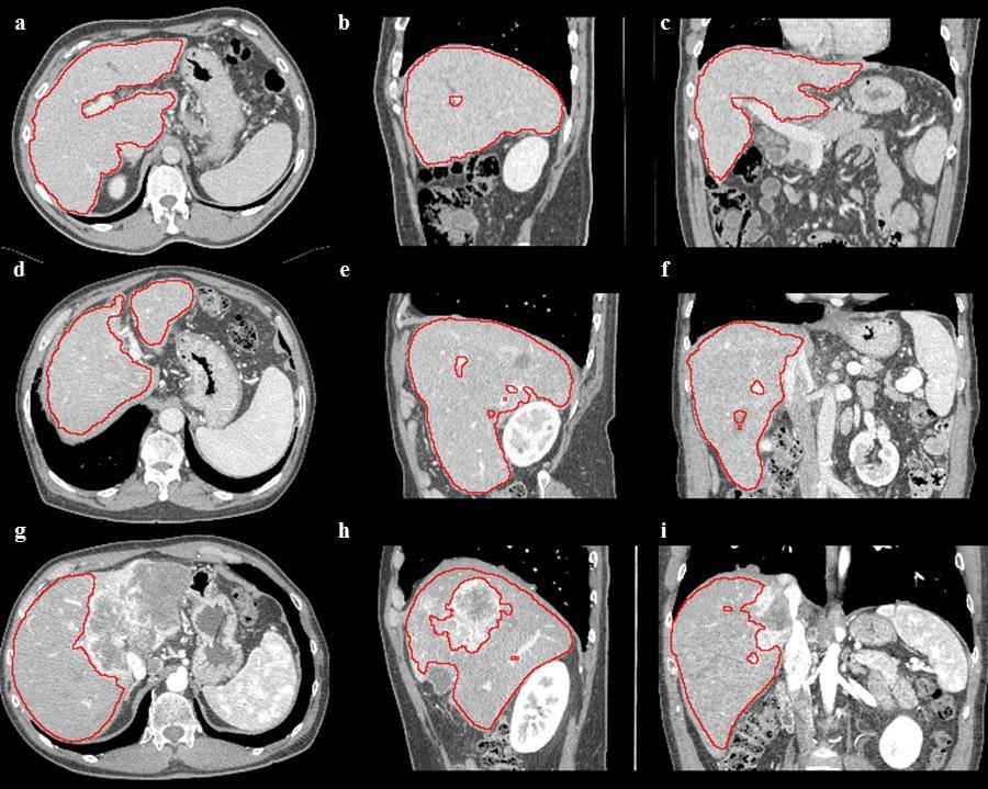 2.2 Multi-phase method for CT images part of the liver was successful only in 45% of the cases, and it failed only in 3.75% of the cases.