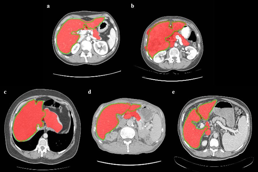 2.2 Multi-phase method for CT images shows an acceptable segmentation that can be used after minor corrections. The bottom row (Fig. 2.