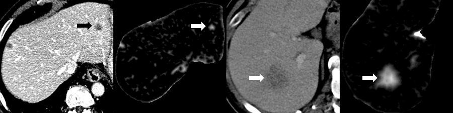 3.1 Automated liver lesion detection for contrast-enhanced CT images In the last step of the preprocessing some basic geometric features of the liver are computed.