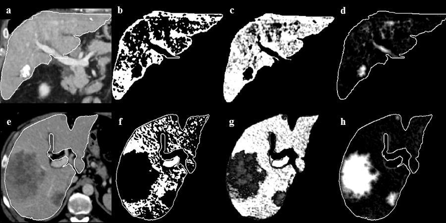 3.1 Automated liver lesion detection for contrast-enhanced CT images continuous value of the result is rounded to the nearest integer number, which results in a discrete abnormality map. Figure 3.