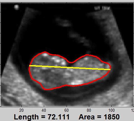 (a) (b) (c) Figure 8. Evolution of the level set contour a week eighth foetus and week sixth foetus. However, the difference of the lengths would not be too much. Fig. 10 shows another measurement result at second angle for a week tenth foetus.