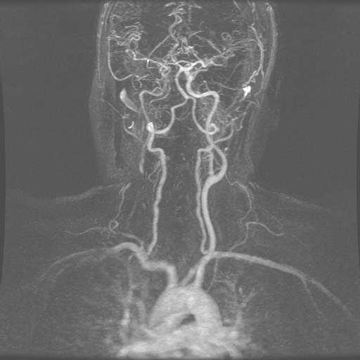 Contrast Enhanced MRA Complete angiographic coverage from