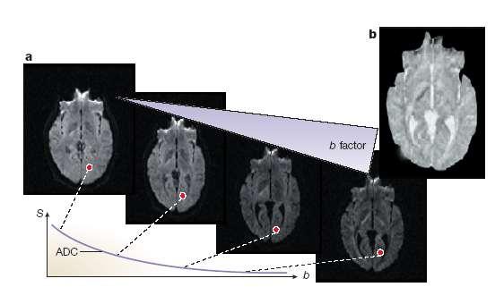 Diffusion-Weighted MRI (DWI) D. Le Bihan.