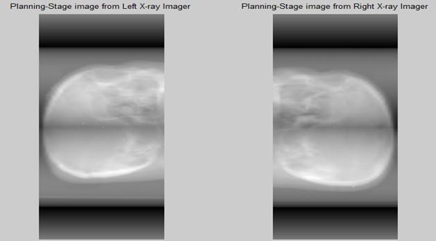 39 Figure 5.5: DRR image are obtained by these two orthogonal X-ray stereotactic imagers. Three light spots can be recognized easily in the projection images.