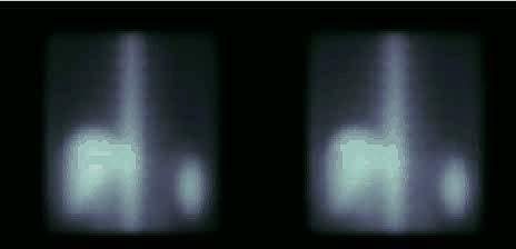 Energy Spectrum Scatter Estimation Example: Triple Energy Window True noise free scatter projection Noise free