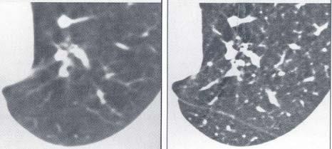 Very thin (1-2 mm) slices, very high contrast resolution. Important in case of large contast differences (e.g., bone - lung).