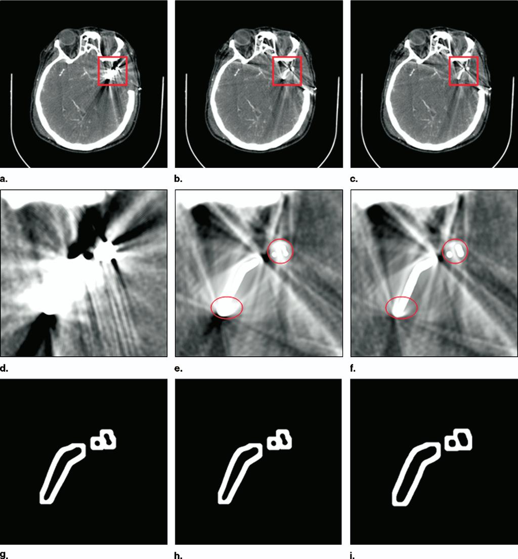Academic Radiology, Vol 14, No 4, April 2007 SEGMENTATION-BASED METHOD Figure 6. Representative images of the patient head reconstructed using different methods.