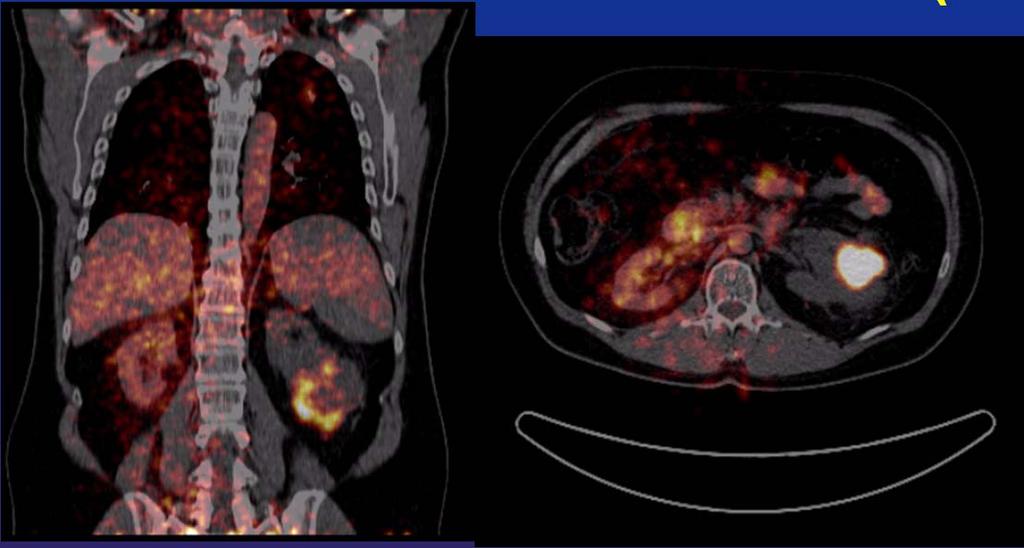 NIH Funded Research: Respiratory Motion Prediction (RMP) in pcasl Perfusion MRI of Clear Cell Renal Cell Carcinoma (ccrcc) 124 I-cG250 PET/CT of ccrcc (~10 s) pcasl MRI sequence Transit with RMP.