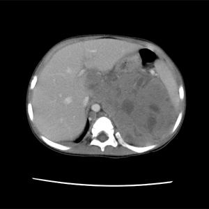 Three different tumors of the abdomen: homogeneous tumor (a), tumor with fuzzy edges (b), heterogeneous tumor with