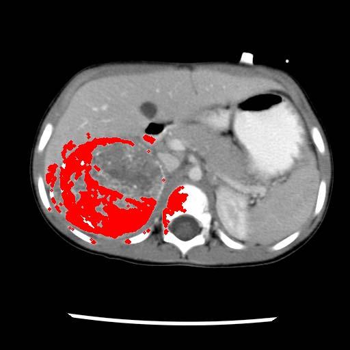 Yellow outlines the approximate tumor, red is the actual segmentation by the algorithm.