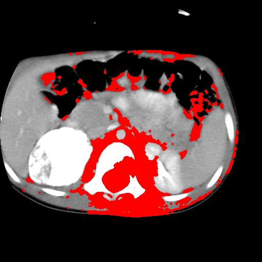 Yellow outlines the approximate tumor, red is the actual segmentation by the