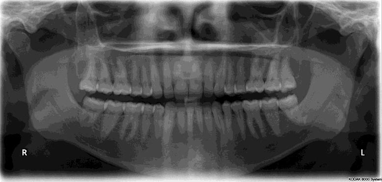 Adaptive histogram equalization Original image Dental Xray Global