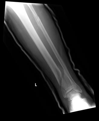 tibia with a fracture.