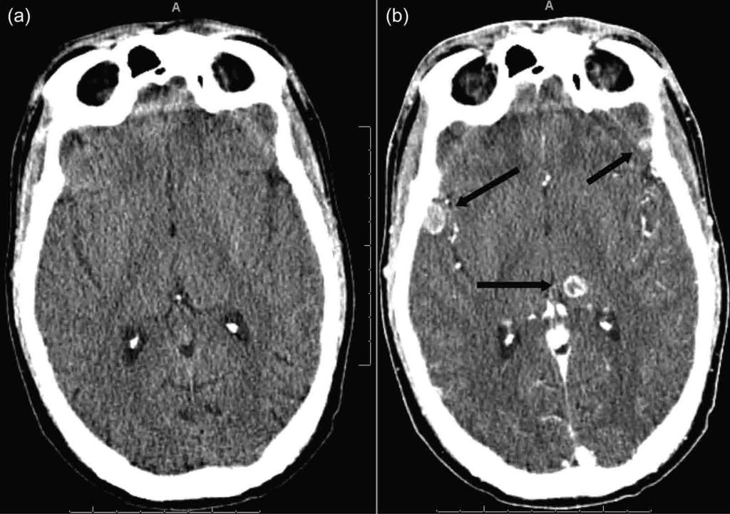 RADIATION DOSE AND IMAGE-QUALITY ASSESSMENT IN COMPUTED TOMOGRAPHY Figure 3.1. Images from a 42-year-old with the new onset of seizures.