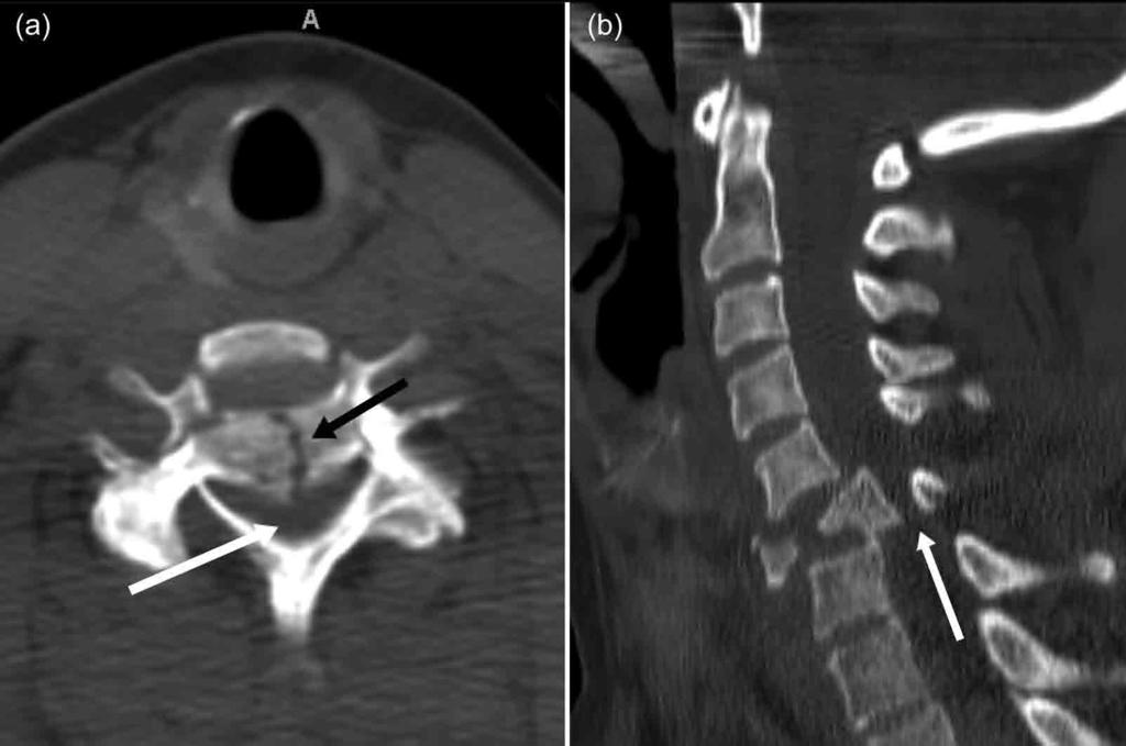 Computed Tomography in Clinical Use Figure 3.3. Images from a 44-year-old with upper and lower extremity paralysis following trauma.