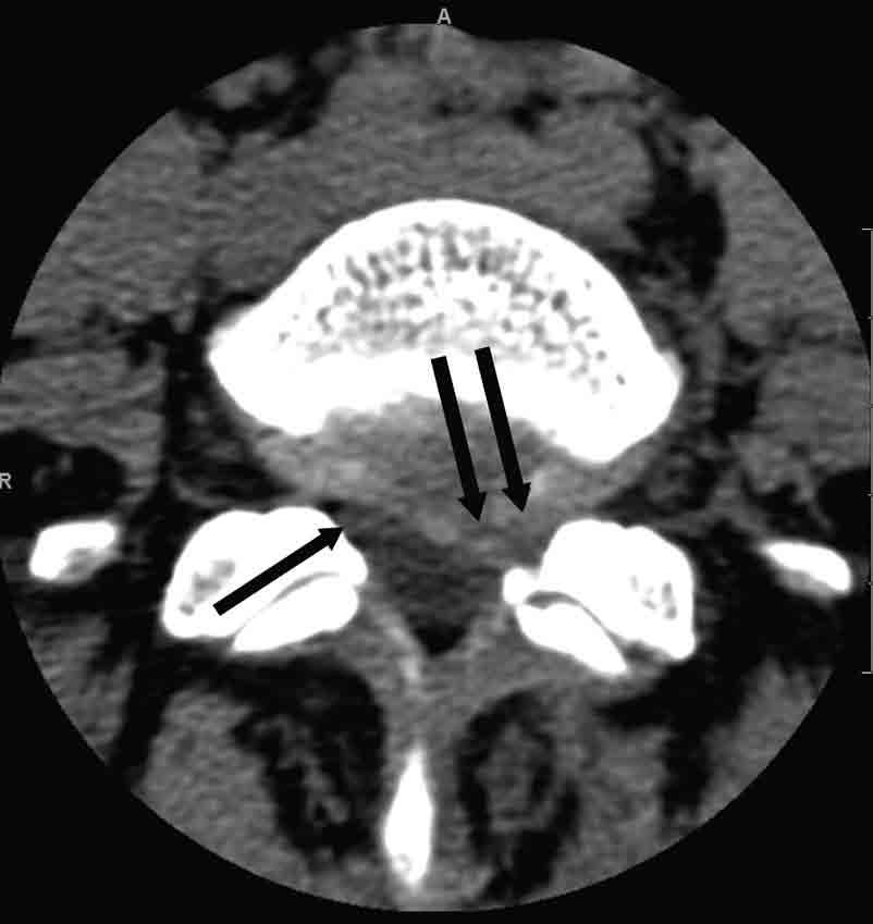 (b) These findings are more clearly demonstrated on reformatted sagittal images.