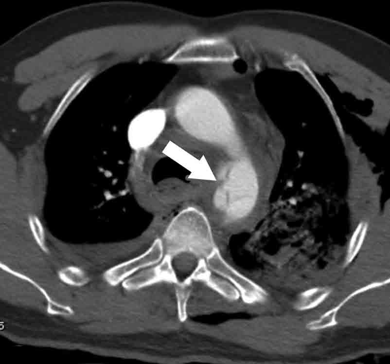black arrow). Figure 3.6. Axial chest CT scan with contrast on a 62-year-old male following a motor-vehicle accident.