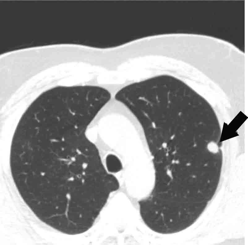 Computed Tomography in Clinical Use Figure 3.8. Axial chest CT scan without contrast in an asymptomatic 73-year-old man. This image shows a 1.4 cm nodule in the left upper lobe.