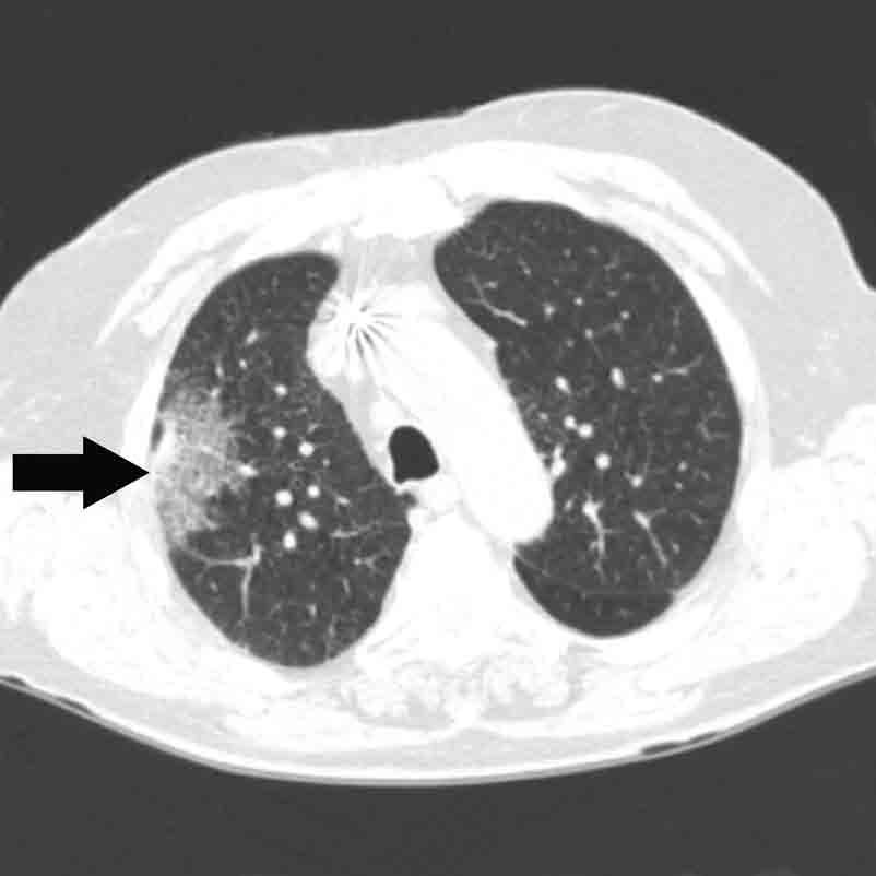 Enlarged hilar and mediastinal lymph nodes, pleural masses and fluid, rib erosion, and chestwall invasion are very suggestive of advanced disease.