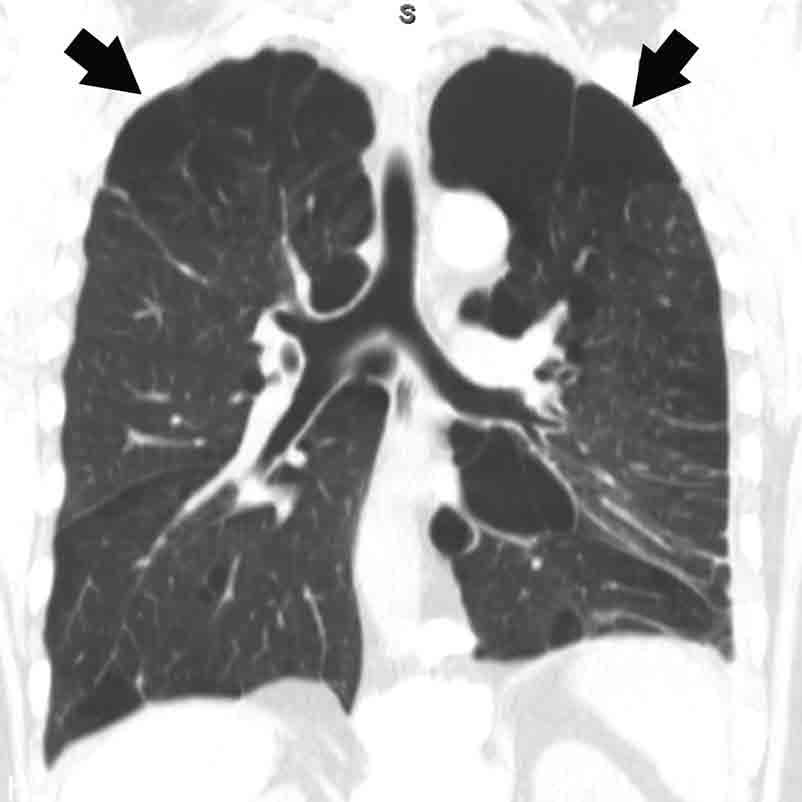 RADIATION DOSE AND IMAGE-QUALITY ASSESSMENT IN COMPUTED TOMOGRAPHY Figure 3.10. Chest CT, coronal reconstruction in a 52-year-old male smoker. The patient complained of increasing shortness of breath.