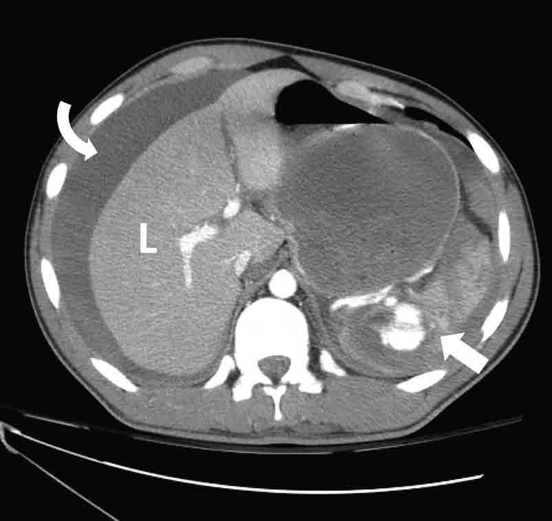 Computed Tomography in Clinical Use Figure 3.12. Coronal CT image from a 45-year-old with right-sided flank pain.