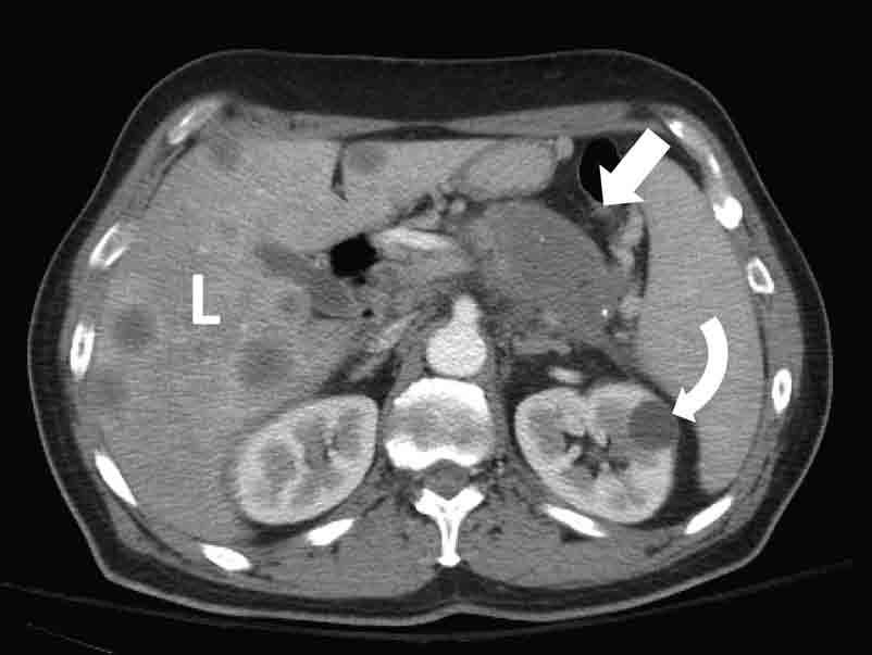(b) Another reformatted coronal image demonstrating the liver (L), kidney (K), and the bladder (B).