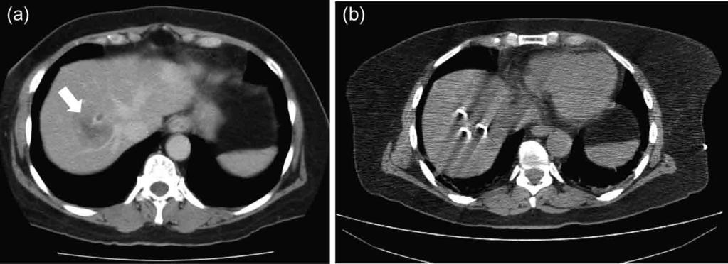 RADIATION DOSE AND IMAGE-QUALITY ASSESSMENT IN COMPUTED TOMOGRAPHY Figure 3.15. Images from a 68-year-old with metastatic colon cancer.