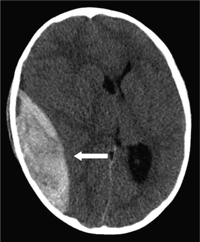(b) This liver lesion was treated with radiofrequency ablation (RFA), and three electrodes used to perform the RFA are seen in the liver. Figure 3.17.