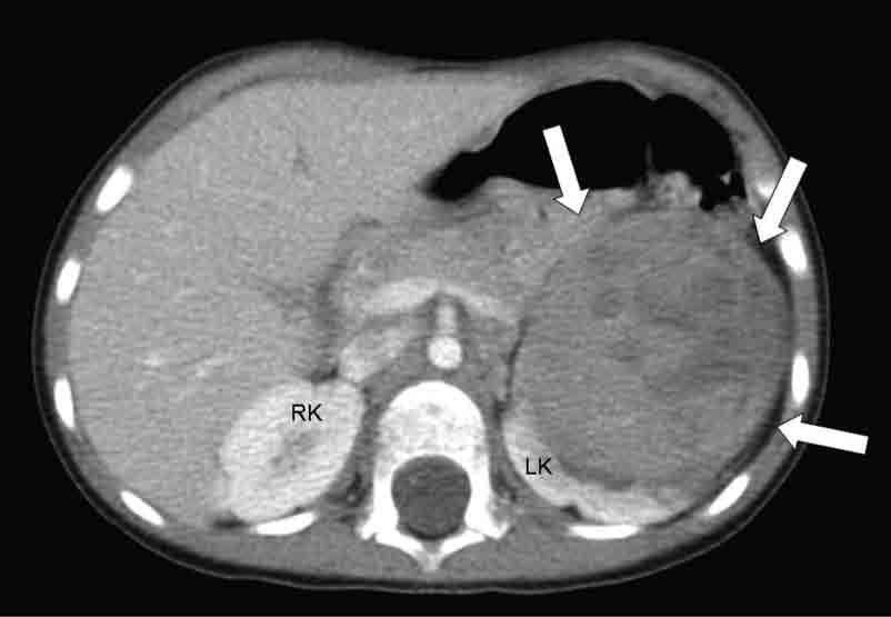 RK, normal right kidney; LK, normal part of left kidney, from which the tumor arises. Figure 3.16. Head CT images of a 5-year-old boy.