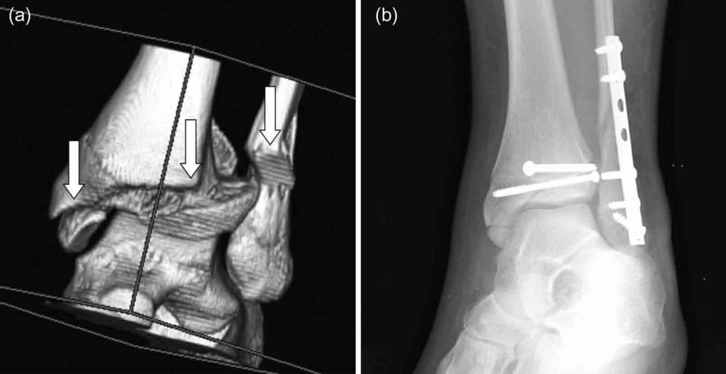 Computed Tomography in Clinical Use Figure 3.18. (a) Three-dimensional reconstruction of a complex (tri-plane) ankle fracture in a 14-year-old boy (arrows show multiple fracture lines).