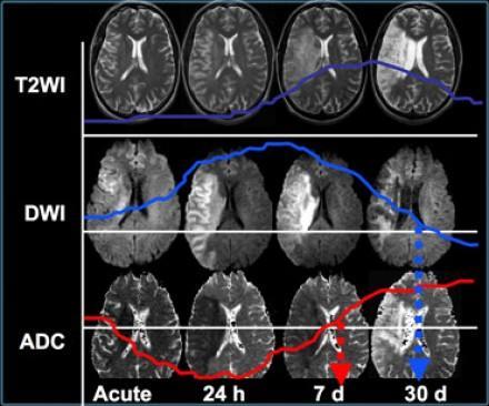 Fig. 1 Comparison of T2 weighted imaging sequence with DWI and ADC Image courtesy: www.radiologyassistant.