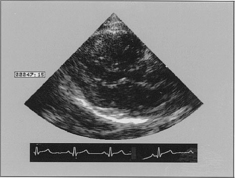 (b) Thus, this pixel is put into the lowpass subband at the corresponding place. (b) Fig. 23. Example of an SAND on a ultrasound picture. (a) Shape to be coded.
