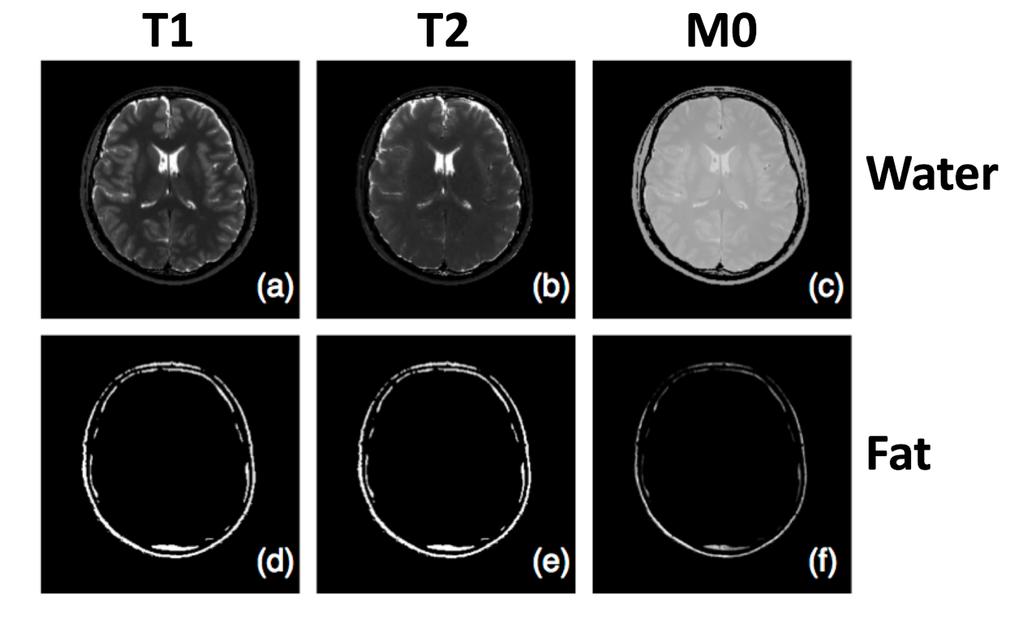 In vivo data set Separate water and fat images were acquired for all scans given in table 2 and 3. Two sets of T1, T2 and M0 maps extracted from these images are presented in figure 10 and 11.