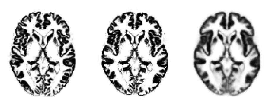 Normalisation T1-Weighted MRI Grey Matter Original Registered