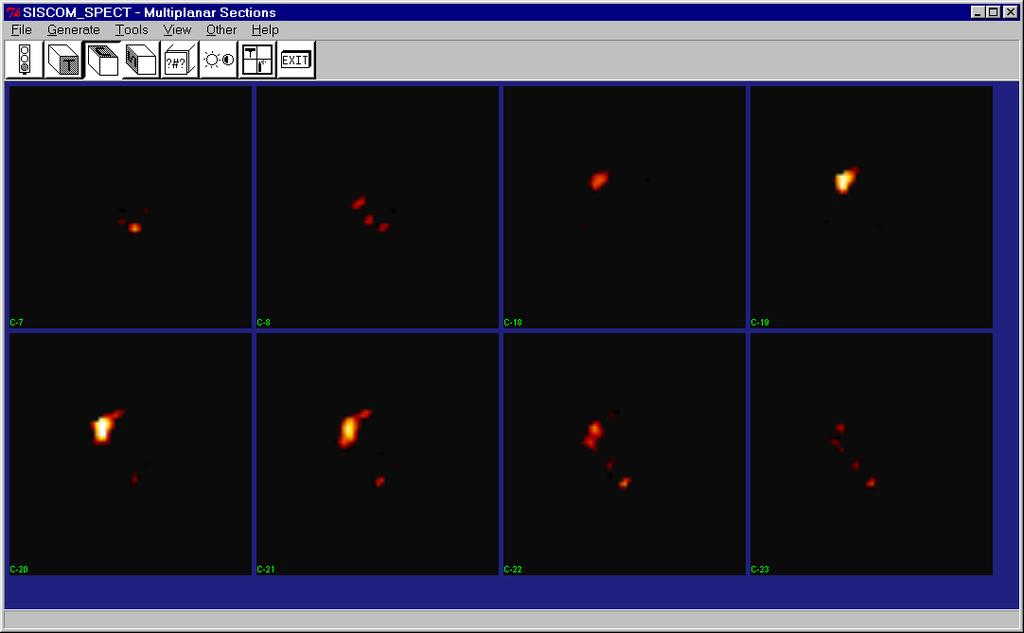 23. Use the Multiplanar Sections module to review the SISCOM_SPECT volume images to see the statistically significant regions of focal activation during the ictal SPECT scan (Figure 26).