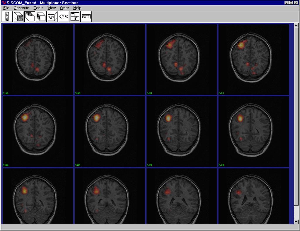 It may also be necessary to change the Intensities parameters in the View submenu to create a better-fused display, as with decreasing the Maximum for the MRI base volume in this case.