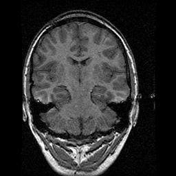 Image Data The SISCOM technique requires acquisition of ictal (during the seizure) and interictal (resting, or between seizures) SPECT images and a MRI volume spanning the entire brain.