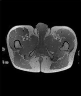 3.4. MR and CT masking In order to exclude objects that don t belong to the pelvic area, such as arms and hardware fixations,