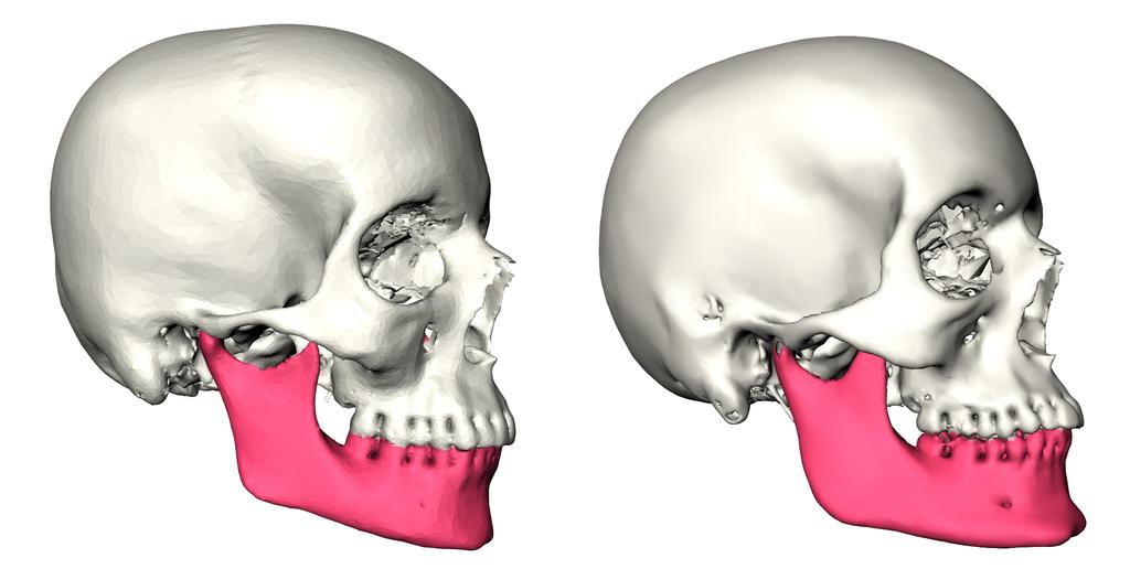 Fig. 3: The labelling of the mandible in the reference skull is transferred to a target skull. References. Michel A. Audette, Frank P. Ferrie, and Terry M. Peters.