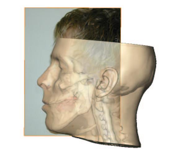 Left: interactive repositioning of the colored parts of the jaw bone model. Right: post-operative photograph of a patient, overlayed with the shape predicted by the soft tissue deformation simulation.