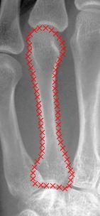 X-Ray Example: Bone Detection Input: