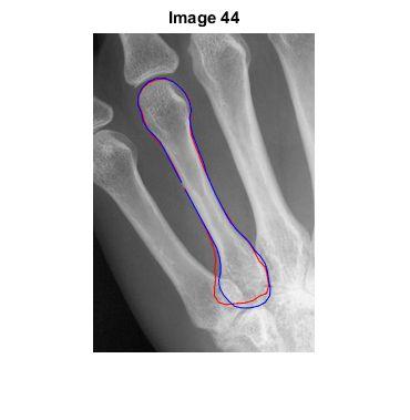 X-Ray Example: Bone Detection Results Medizinische