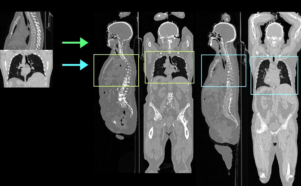 CT Example: 3D Image Search - Khresmoi Input: CT Volumes Methods