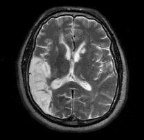 This proposed strategy focus on detection and extraction of brain stroke from different patient s MRI images.