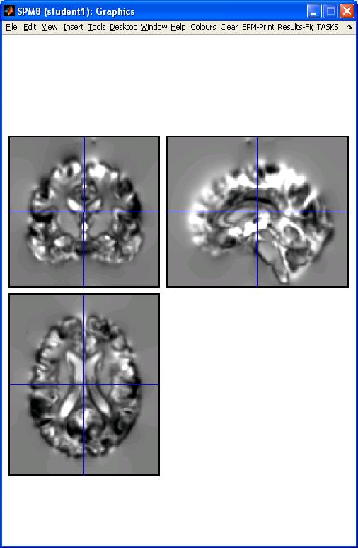 Preprocessing with Dartel fmri time-series Anatomical MRI TPMs.