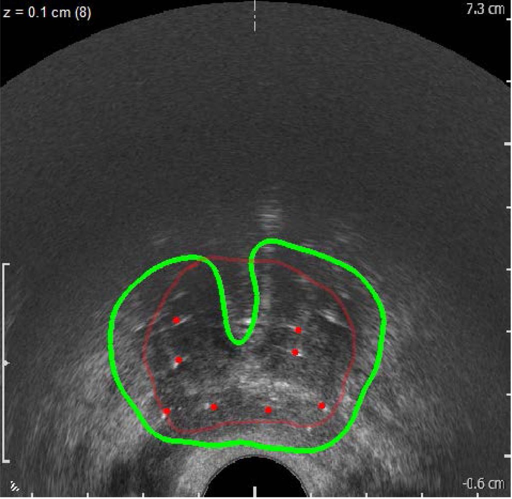 Kuo et al. Page 10 Figure 5. Intraoperative dosimetry result showing cold spot.