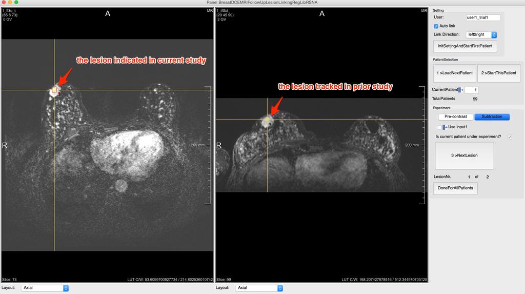 Figure 9: The software prototype used in clinical evaluation study: current and prior subtraction images are visualized in left and right viewers.
