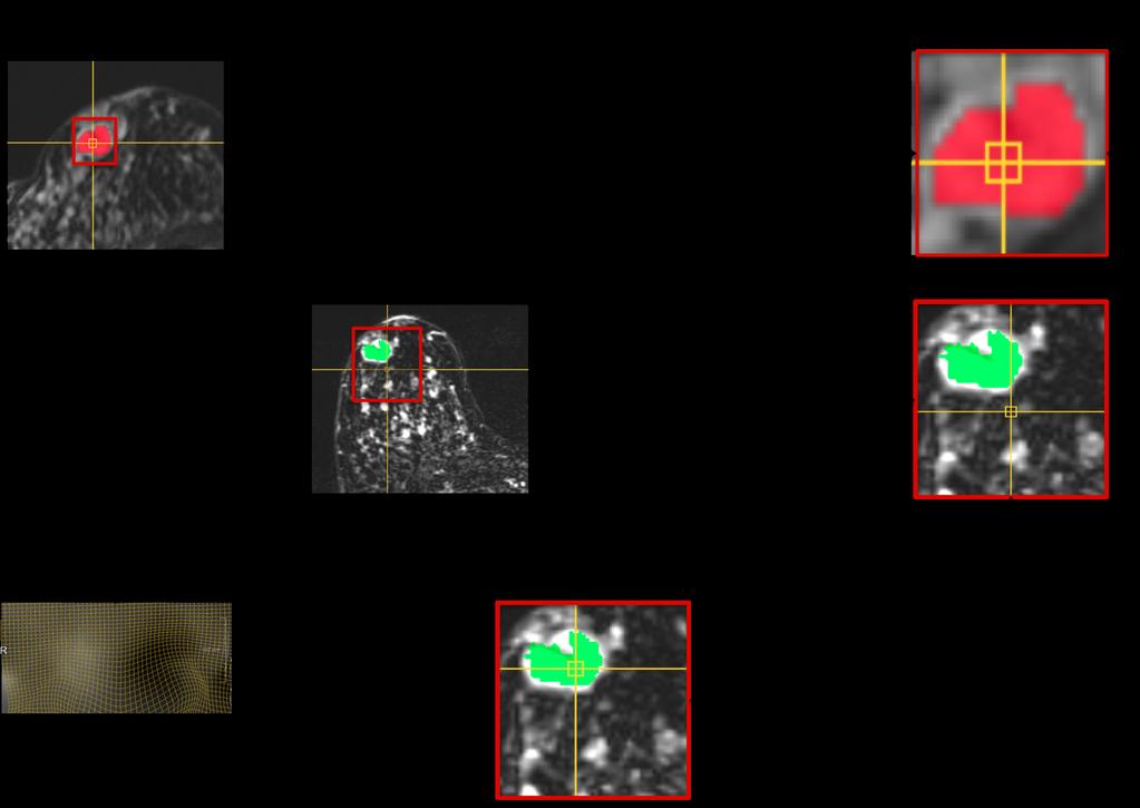 Figure 4: Work flow of spatially linking the lesions in current and prior MRI using intensity-based matching algorithm.